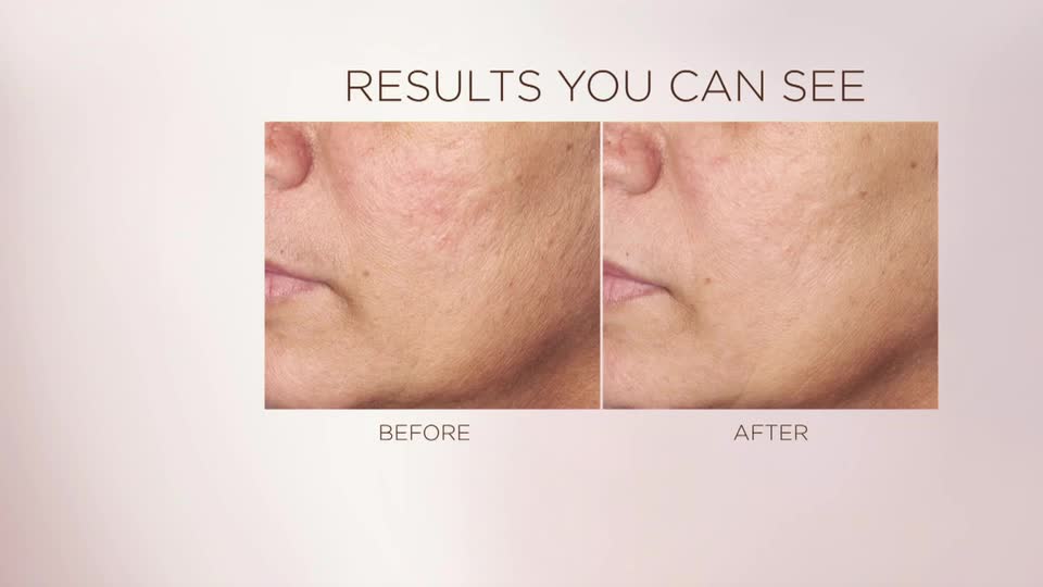 A woman's cheek shows a noticeable reduction in redness and blemishes. The skin looks smoother and more even-toned in the "after" comparison.