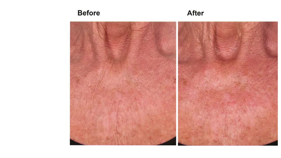 The skin on this person's neck appears smoother and less creased in the "after" shot.  The redness has also softened, making the skin look more even.