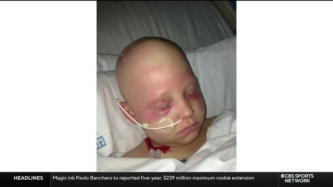 A young child lies still, eyes closed, in a hospital bed. A thin tube rests in their nose, and their face is marked with bruising.
