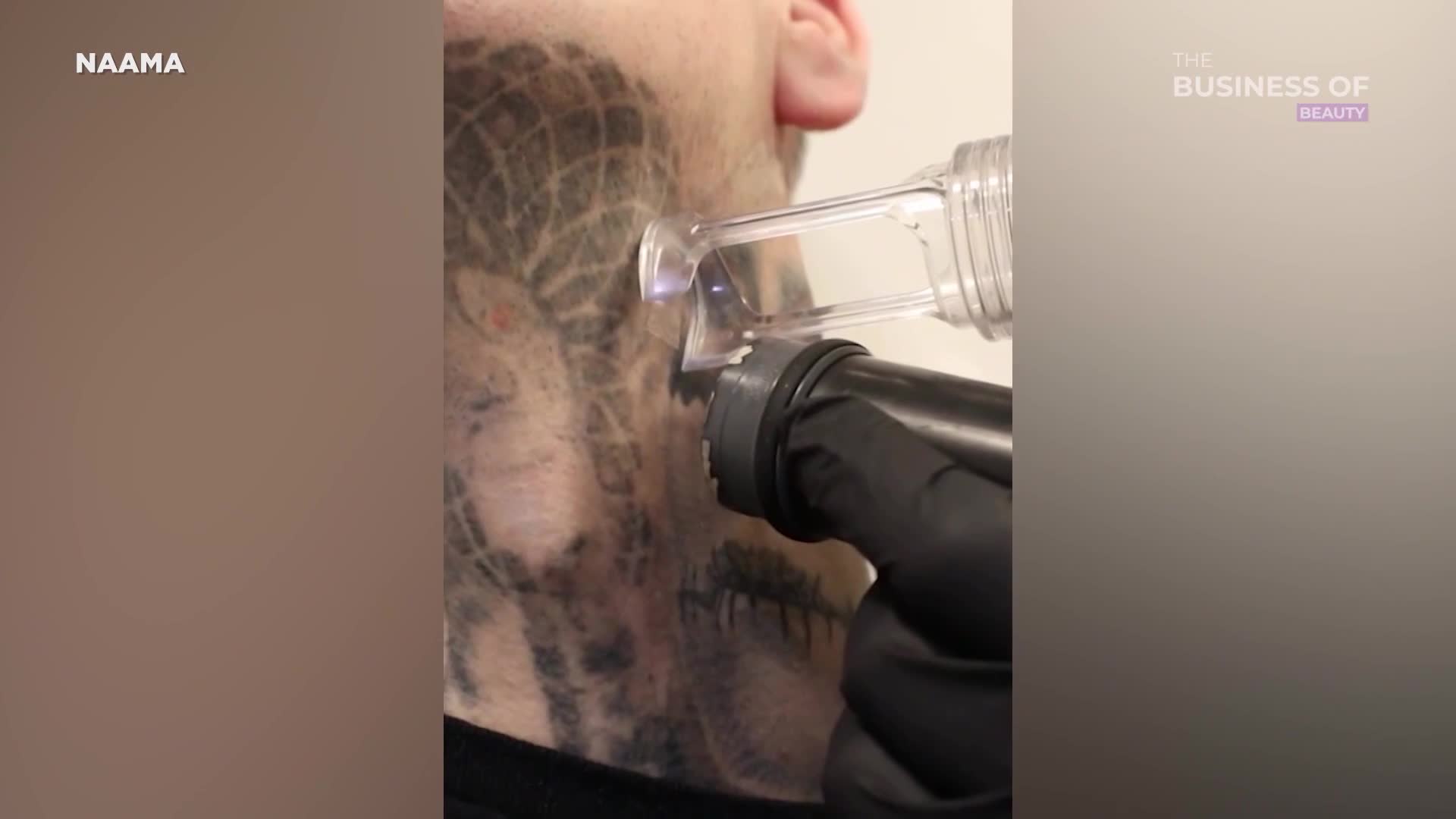 A technician, gloved in black, is using a laser to remove a large, dark tattoo from someone's neck. The laser device, with a clear nozzle, emits a small spark as it moves across the skin.
