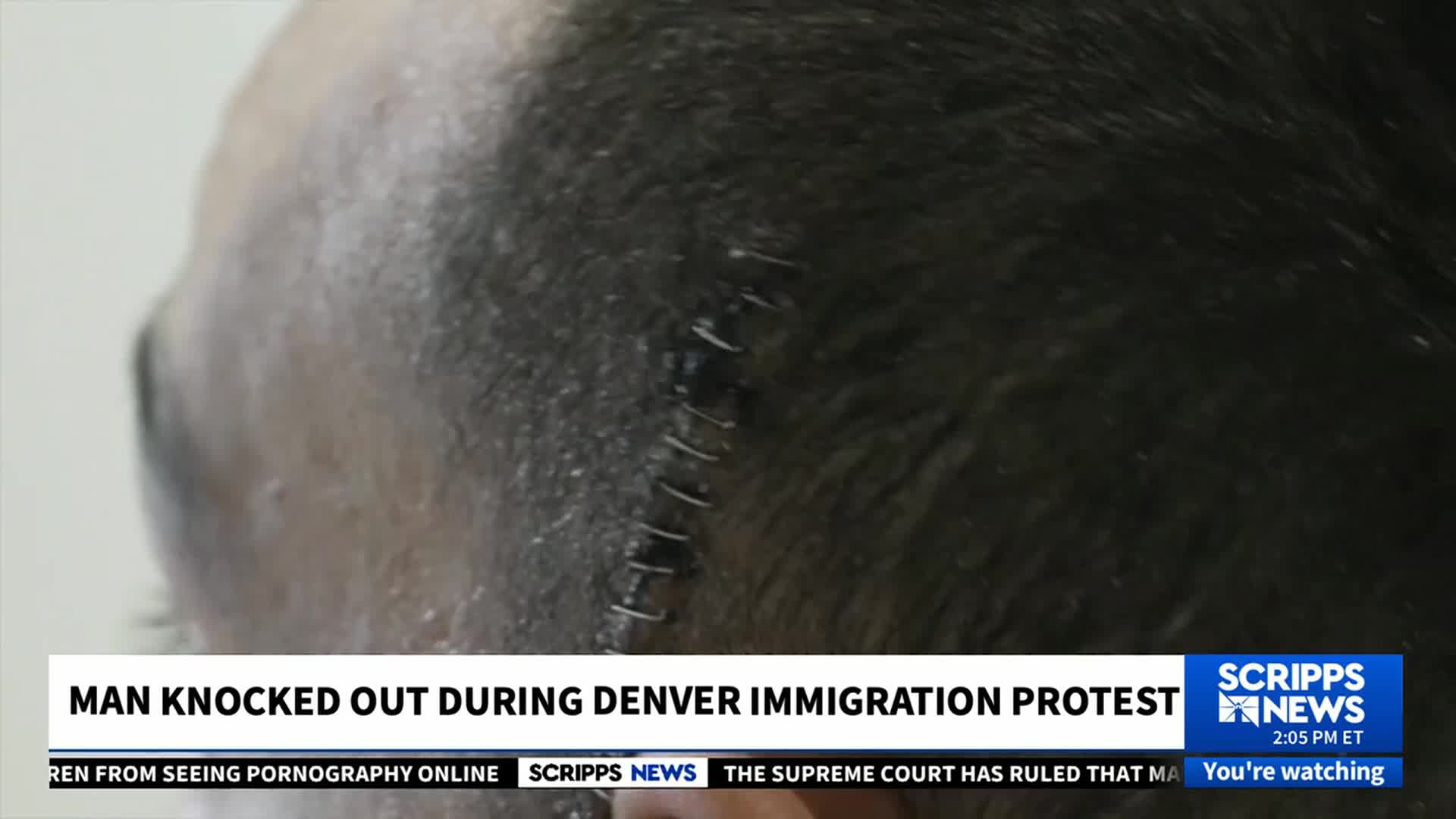 A stitched wound runs across the top of a man's head, likely from an incident during a Denver immigration protest, as reported by Scripps News. The close-up focuses on the injury, with the headline clearly indicating the event's context.
